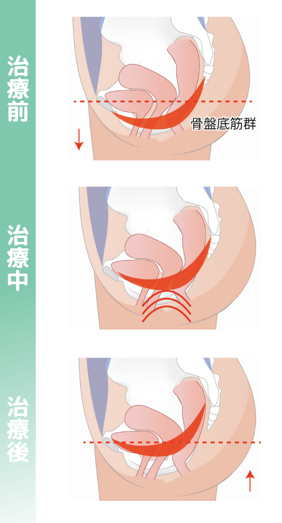 骨盤底筋における変化