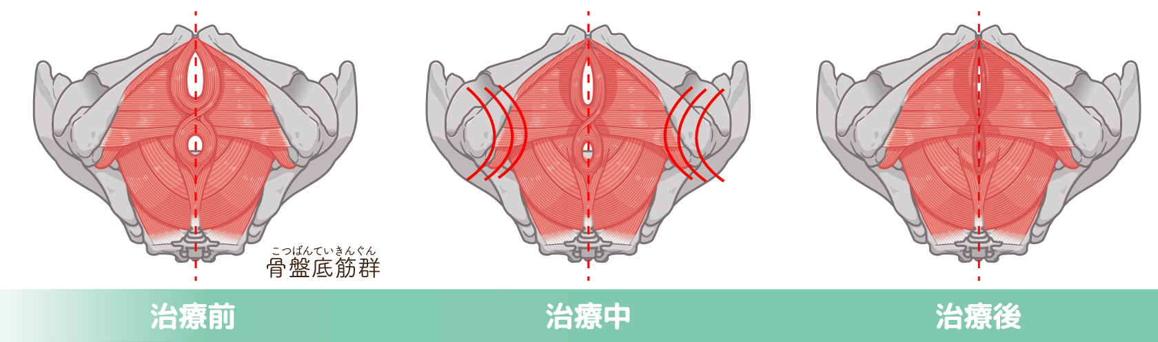 骨盤底筋における変化