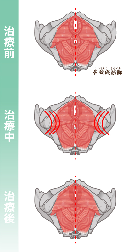 骨盤底筋における変化